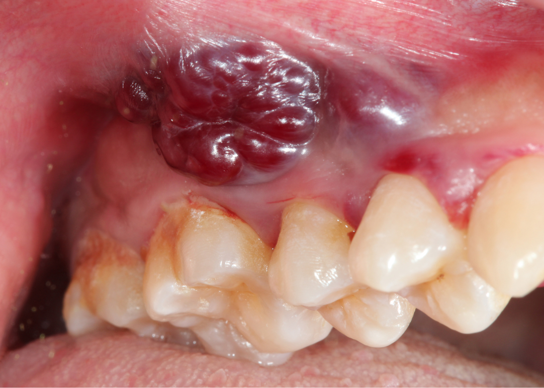 Oral & Tongue Cancer Surgery